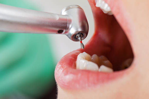Best Emergency Root Canal Treatment in Oak Grove, AL